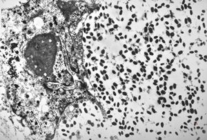 F, 24y. | molluscum contagiosum F, 24y. | molluscum contagiosum
